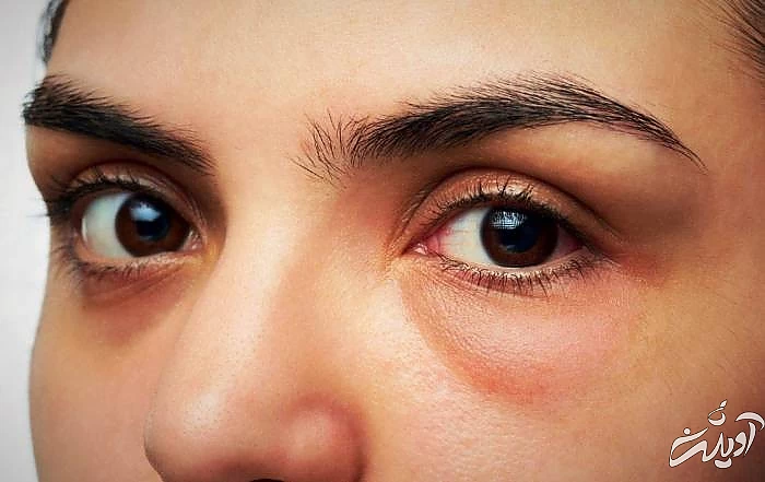 نمک برای درمان پف چشم ها درمان پف چشم